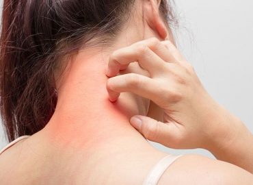 Atopowe zapalenie skóry – przyczyny, leczenie, prewencja