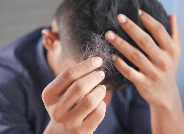 Wypadanie włosów – alopecja i sposoby jej leczenia