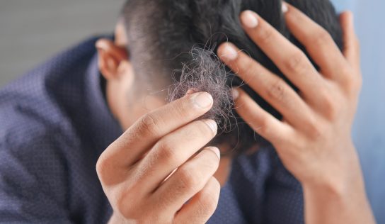 Wypadanie włosów – alopecja i sposoby jej leczenia