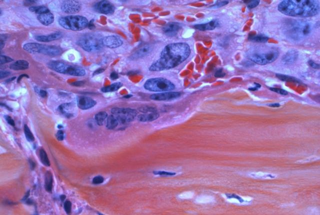 Markery nowotworowe – jakie są pomocne w diagnostyce?